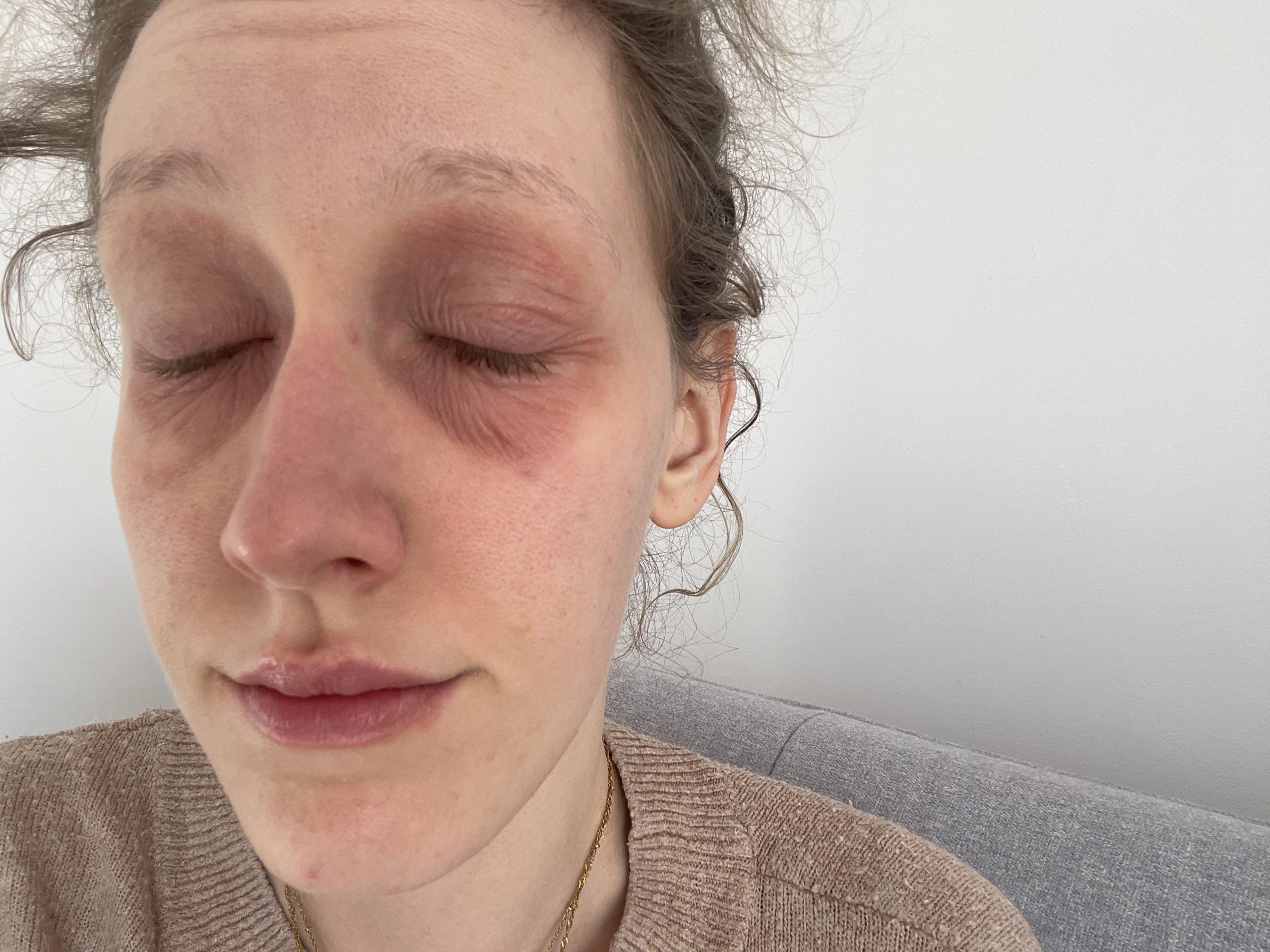 Gabriela w 2022 roku &mdash; alergia